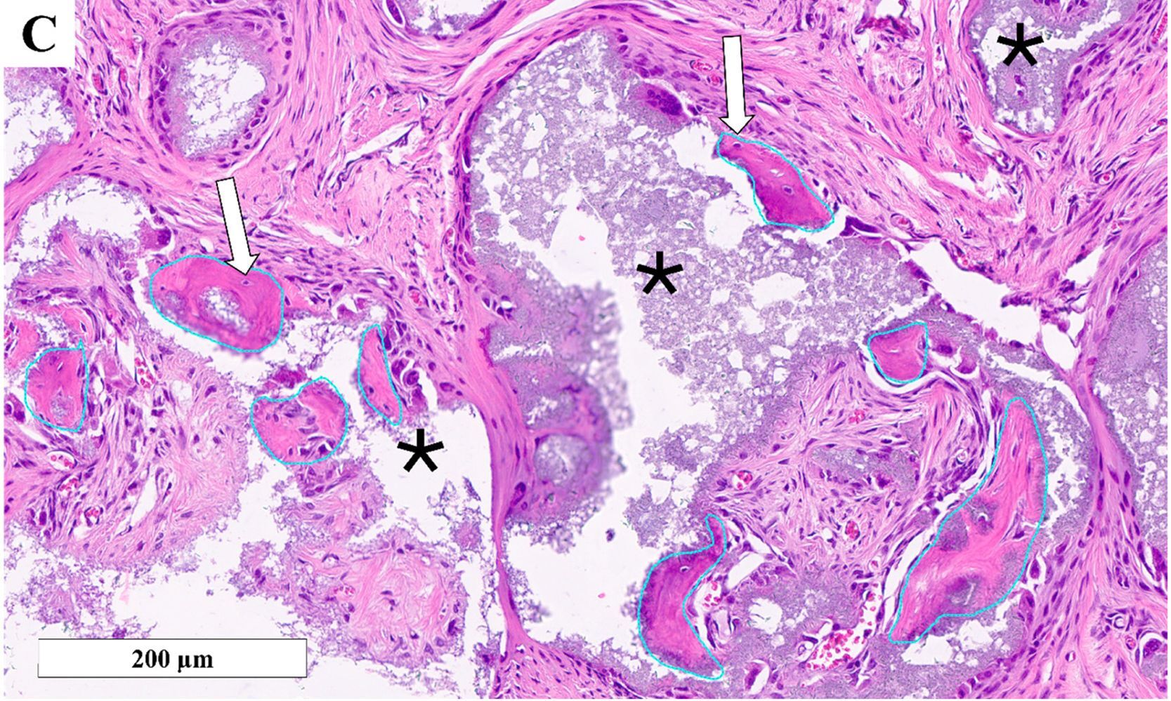Calcium-Deficient Hydroxyapatite: The Hidden Layer That Determines Bone Regeneration