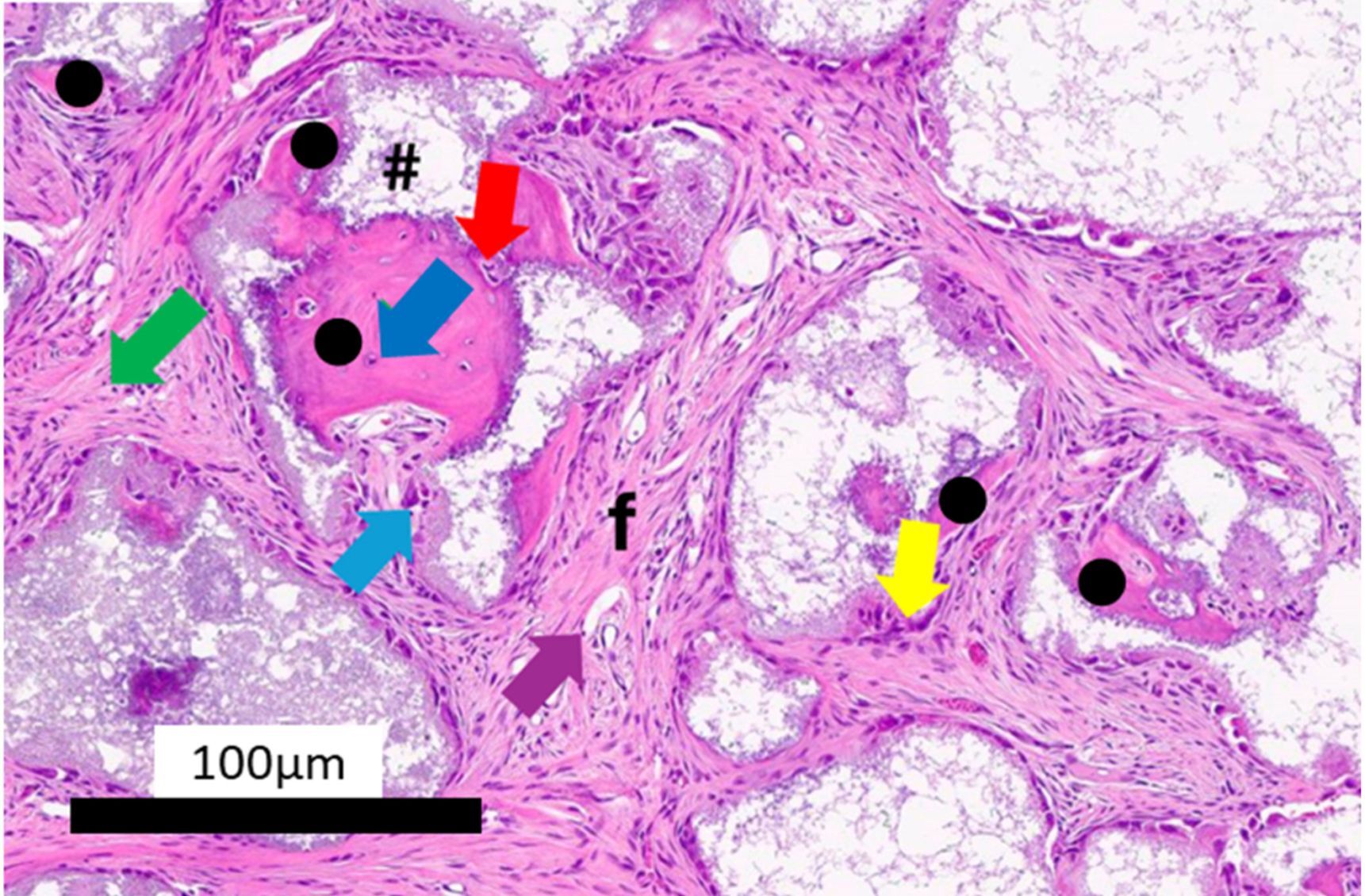 Unsere Publikation zu Material­induzierter heterotoper Ossifikation
